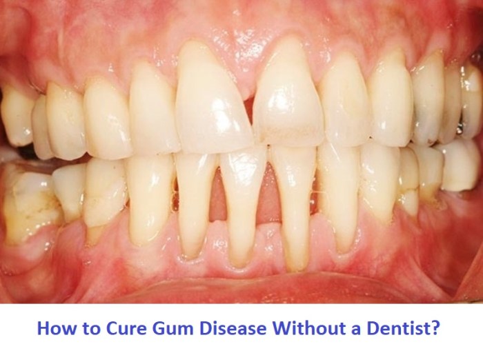 How to Cure Gum Disease at Home: A Guide to Natural Remedies and OTC Treatments