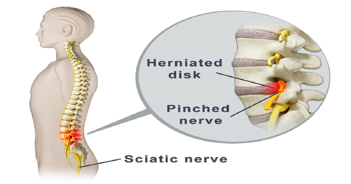 How can stiff and tight muscles result in back pain?